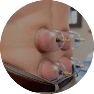 Functional Cupping of a patient for lower back pain at ICE